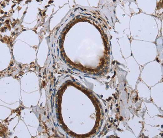 Immunohistochemistry of paraffin-embedded Human breast cancer using FBP1 Polyclonal Antibody at dilution of 1:40