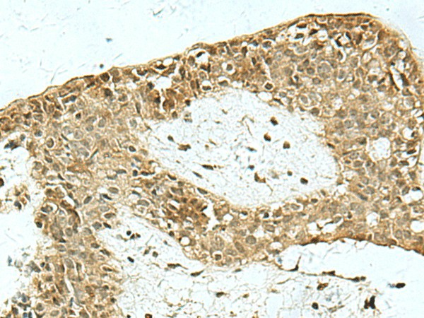 Immunohistochemistry of paraffin-embedded Human breast cancer tissue  using KAT7 Polyclonal Antibody at dilution of 1:55(?200)