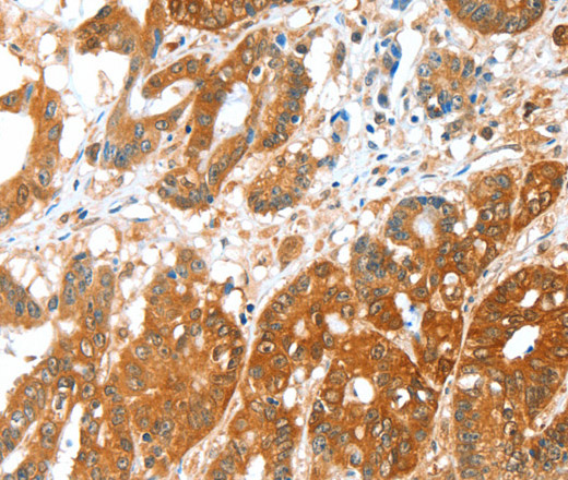 Immunohistochemistry of paraffin-embedded Human colon cancer tissue using ALDH5A1 Polyclonal Antibody at dilution 1:35