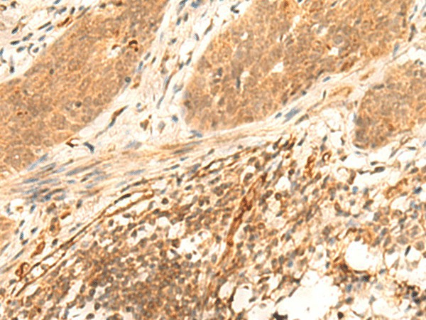 Immunohistochemistry of paraffin-embedded Human esophagus cancer tissue  using HES7 Polyclonal Antibody at dilution of 1:25(?200)