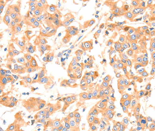 Immunohistochemistry of paraffin-embedded Human breast cancer tissue using Factor XIIIa Polyclonal Antibody at dilution 1:80