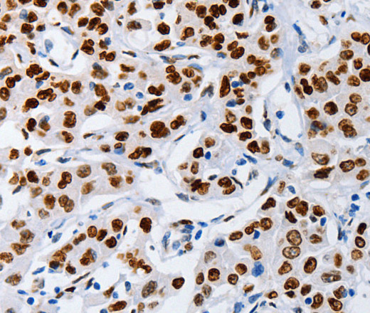 Immunohistochemistry of paraffin-embedded Human lung cancer using MUTYH Polyclonal Antibody at dilution of 1:60