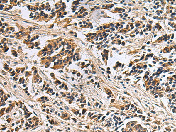 Immunohistochemistry of paraffin-embedded Human breast cancer tissue  using DIAPH2 Polyclonal Antibody at dilution of 1:55(?200)