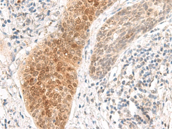 Immunohistochemistry of paraffin-embedded Human esophagus cancer tissue  using GHDC Polyclonal Antibody at dilution of 1:90(?200)