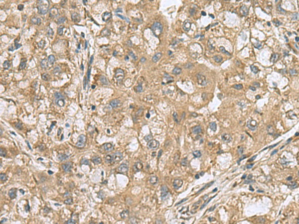 Immunohistochemistry of paraffin-embedded Human liver cancer tissue  using PAPSS2 Polyclonal Antibody at dilution of 1:60(?200)