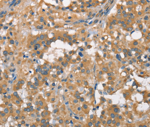 Immunohistochemistry of paraffin-embedded Human thyroid cancer using PLEKHO1 Polyclonal Antibody at dilution of 1:70