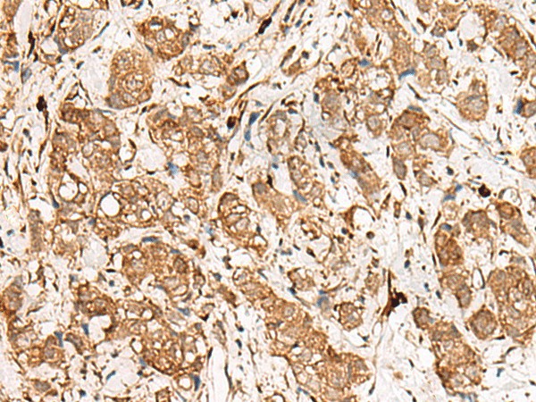 Immunohistochemistry of paraffin-embedded Human breast cancer tissue  using GBP4 Polyclonal Antibody at dilution of 1:45(?200)