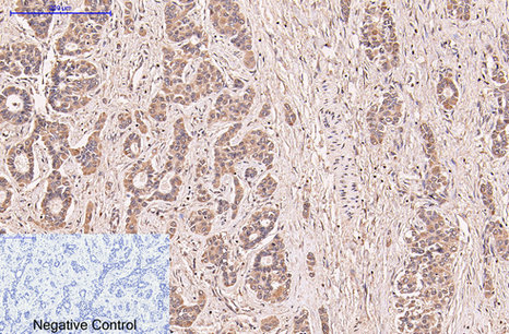 Immunohistochemistry of paraffin-embedded Human liver cancer tissue using CD5 Monoclonal Antibody at dilution of 1:200.