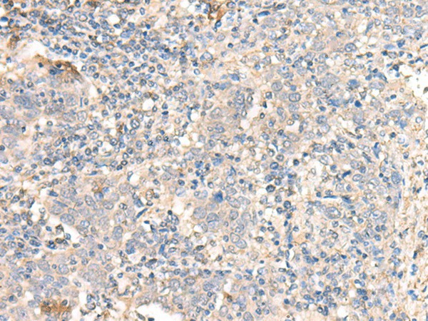 Immunohistochemistry of paraffin-embedded Human cervical cancer tissue  using PARS2 Polyclonal Antibody at dilution of 1:30(?200)