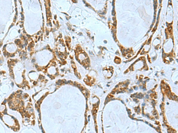 Immunohistochemistry of paraffin-embedded Human thyroid cancer tissue  using TSGA10 Polyclonal Antibody at dilution of 1:50(?200)