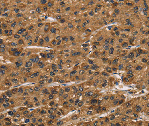 Immunohistochemistry of paraffin-embedded Human liver cancer tissue using ATP7A  Polyclonal Antibody at dilution 1:50