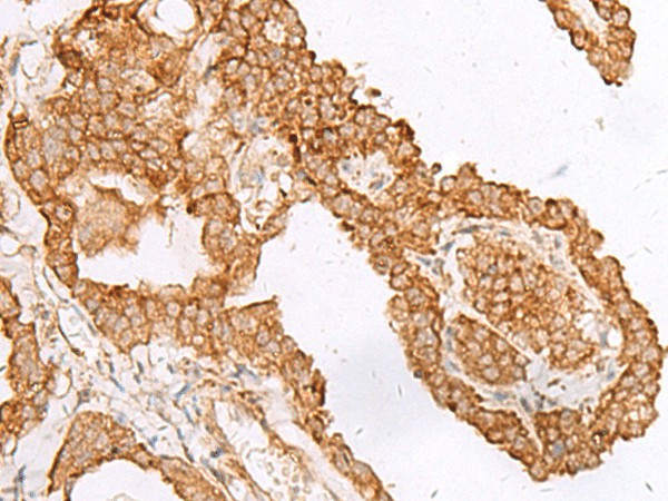 Immunohistochemistry of paraffin-embedded Human thyroid cancer tissue  using FAM200A Polyclonal Antibody at dilution of 1:45(?200)