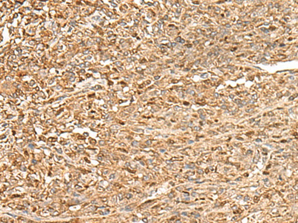 Immunohistochemistry of paraffin-embedded Human liver cancer tissue  using ZC3H7A Polyclonal Antibody at dilution of 1:50(?200)