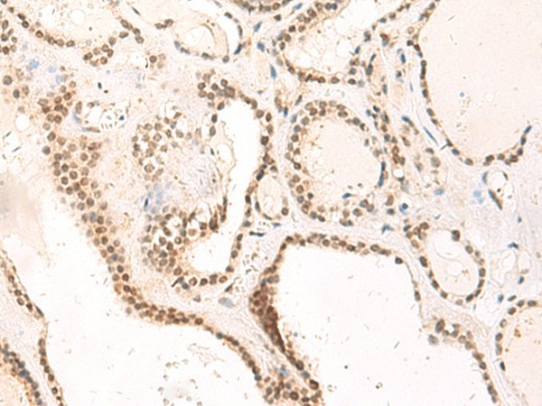 Immunohistochemistry of paraffin-embedded Human thyroid cancer tissue  using TEAD3 Polyclonal Antibody at dilution of 1:50(?200)