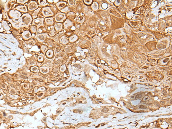 Immunohistochemistry of paraffin-embedded Human esophagus cancer tissue  using IL6ST Polyclonal Antibody at dilution of 1:40(?200)