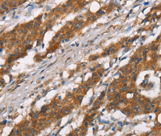 Immunohistochemistry of paraffin-embedded Human gasrtic cancer tissue using DSC2 Polyclonal Antibody at dilution 1:35