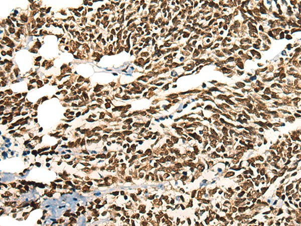 Immunohistochemistry of paraffin-embedded Human lung cancer tissue  using MORF4L2 Polyclonal Antibody at dilution of 1:25(?200)