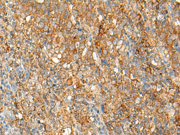 Immunohistochemistry of paraffin-embedded Human cervical cancer tissue  using HLA-DRB1 Polyclonal Antibody at dilution of 1:35(?200)