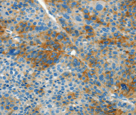 Immunohistochemistry of paraffin-embedded Human liver cancer tissue using L1CAM Polyclonal Antibody at dilution 1:40