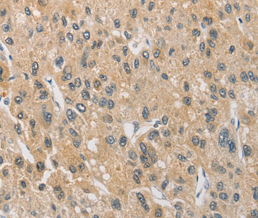 Immunohistochemistry of paraffin-embedded Human liver cancer tissue using ARHGEF5 Polyclonal Antibody at dilution 1:40