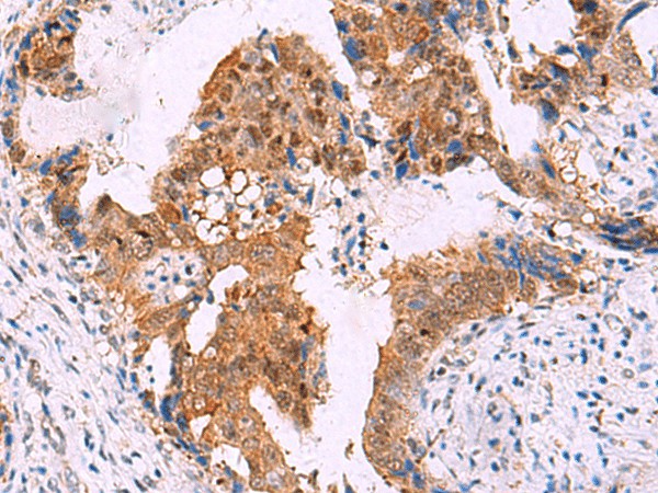 Immunohistochemistry of paraffin-embedded Human cervical cancer tissue  using FKBP4 Polyclonal Antibody at dilution of 1:65(?200)