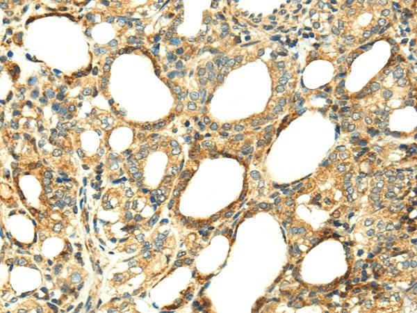 Immunohistochemistry of paraffin-embedded Human thyroid cancer tissue using SERPINA12 Polyclonal Antibody at dilution 1:40