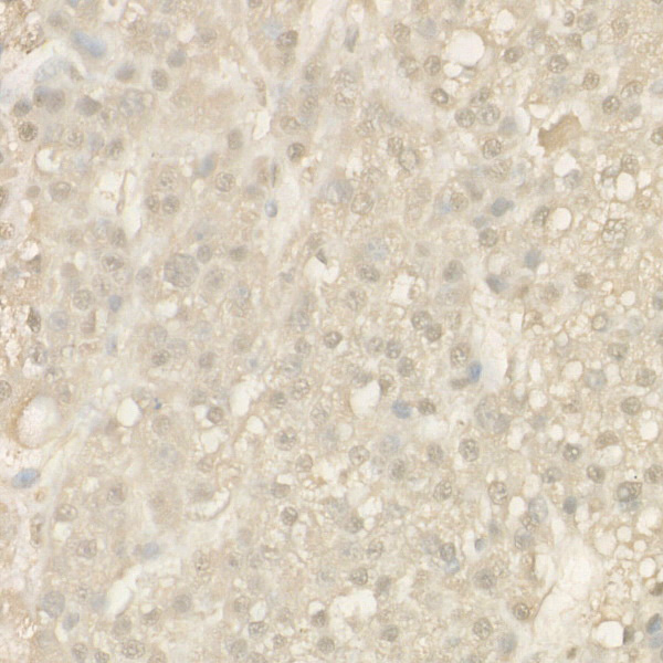 Immunohistochemistry of paraffin-embedded human liver cancer using Cleaved Caspase-9 P37 Polyclonal Antibody at dilution of 1:50 (40x lens).Perform high pressure antigen retrieval with 10 mM citrate buffer pH 6.0 before commencing with IHC staining protocol.