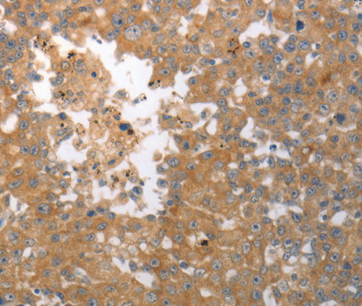 Immunohistochemistry of paraffin-embedded Human breast cancer tissue using SHH Polyclonal Antibody at dilution 1:40