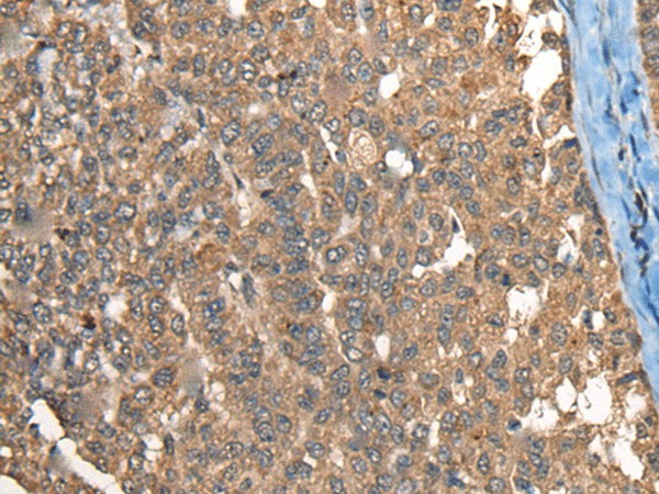 Immunohistochemistry of paraffin-embedded Human liver cancer tissue  using C1R Polyclonal Antibody at dilution of 1:40(?200)