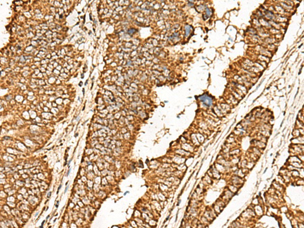 Immunohistochemistry of paraffin-embedded Human colorectal cancer tissue  using ATP5I Polyclonal Antibody at dilution of 1:65(?200)