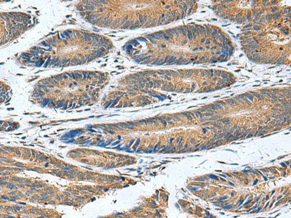 Immunohistochemistry of paraffin-embedded Human colorectal cancer tissue  using CLEC1B Polyclonal Antibody at dilution of 1:55(?200)