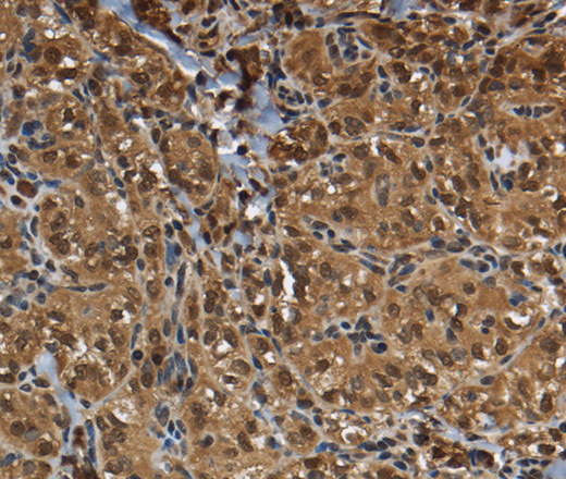 Immunohistochemistry of paraffin-embedded Human thyroid cancer using GLO1 Polyclonal Antibody at dilution of 1:50