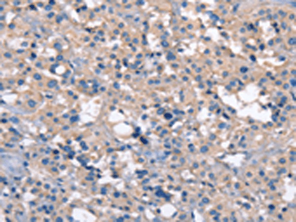 Immunohistochemistry of paraffin-embedded Human thyroid cancer tissue  using ZFYVE16  Polyclonal Antibody at dilution of 1:60(?200)