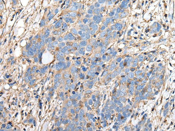 Immunohistochemistry of paraffin-embedded Human thyroid cancer tissue  using PLA2G16 Polyclonal Antibody at dilution of 1:40(?200)