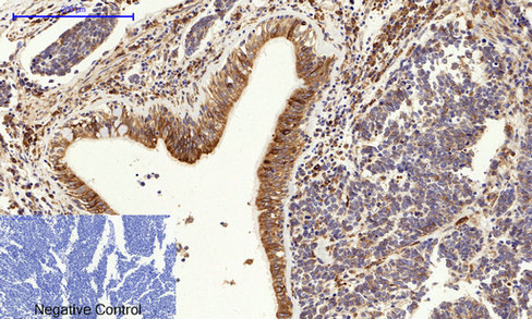 Immunohistochemistry of paraffin-embedded Human lung cancer tissue using CANX Polyclonal Antibody at dilution of 1:200.