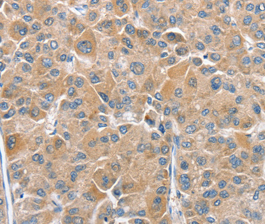 Immunohistochemistry of paraffin-embedded Human liver cancer tissue using CHMP4B Polyclonal Antibody at dilution 1:40