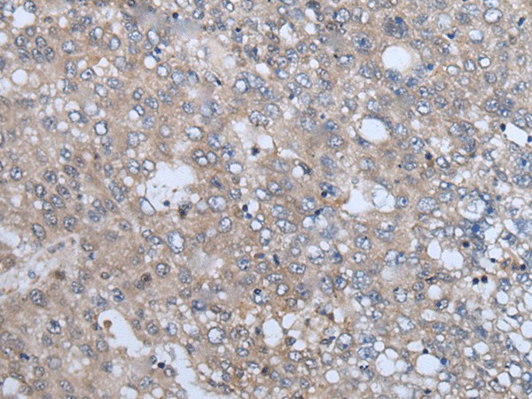 Immunohistochemistry of paraffin-embedded Human liver cancer tissue  using VAMP4 Polyclonal Antibody at dilution of 1:50(?200)