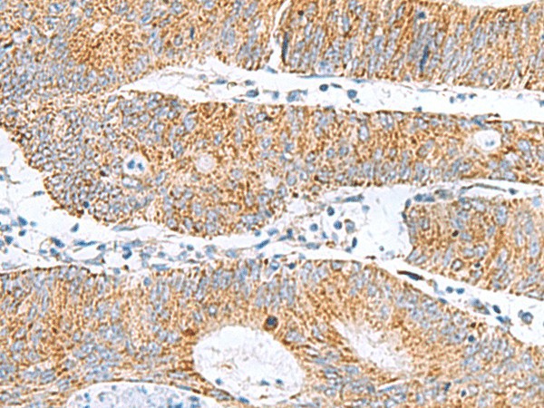 Immunohistochemistry of paraffin-embedded Human colorectal cancer tissue  using GCSH Polyclonal Antibody at dilution of 1:60(?200)