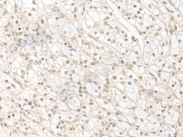 Immunohistochemistry of paraffin-embedded Human kidney cancer tissue  using HENMT1 Polyclonal Antibody at dilution of 1:30(?200)