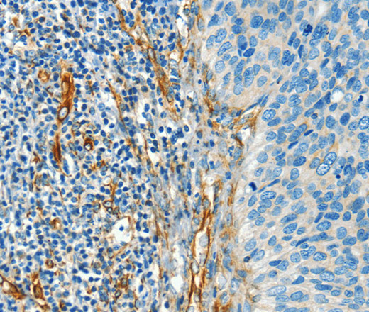 Immunohistochemistry of paraffin-embedded Human cervical cancer tissue using DIO2 Polyclonal Antibody at dilution 1:50