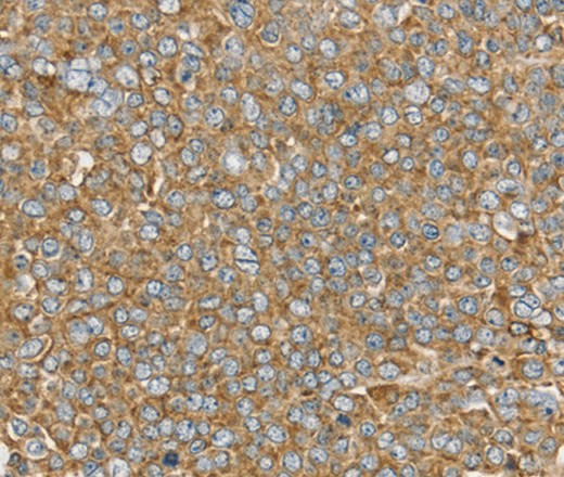 Immunohistochemistry of paraffin-embedded Human ovarian cancer using PTGER2 Polyclonal Antibody at dilution of 1:45