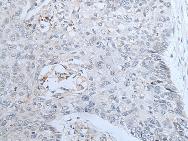 Immunohistochemistry of paraffin-embedded Human lung cancer tissue  using CENPF Polyclonal Antibody at dilution of 1:60(?200)