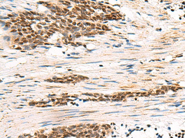 Immunohistochemistry of paraffin-embedded Human esophagus cancer tissue  using GABPB1 Polyclonal Antibody at dilution of 1:55(?200)