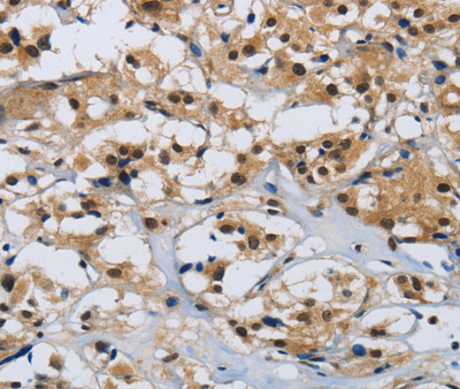 Immunohistochemistry of paraffin-embedded Human thyroid cancer tissue using CMTM8 Polyclonal Antibody at dilution 1:40