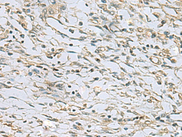 Immunohistochemistry of paraffin-embedded Human prost ate cancer tissue  using RAB3IP Polyclonal Antibody at dilution of 1:60(?200)