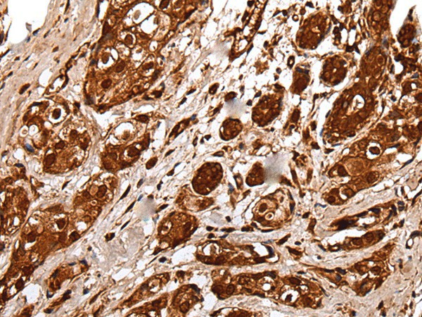 Immunohistochemistry of paraffin-embedded Human breast cancer tissue  using UBE2V1 Polyclonal Antibody at dilution of 1:30(?200)