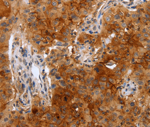 Immunohistochemistry of paraffin-embedded Human lung cancer using PLAUR Polyclonal Antibody at dilution of 1:50