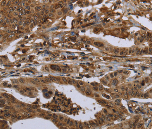 Immunohistochemistry of paraffin-embedded Human gastric cancer tissue using HPGD Polyclonal Antibody at dilution 1:30