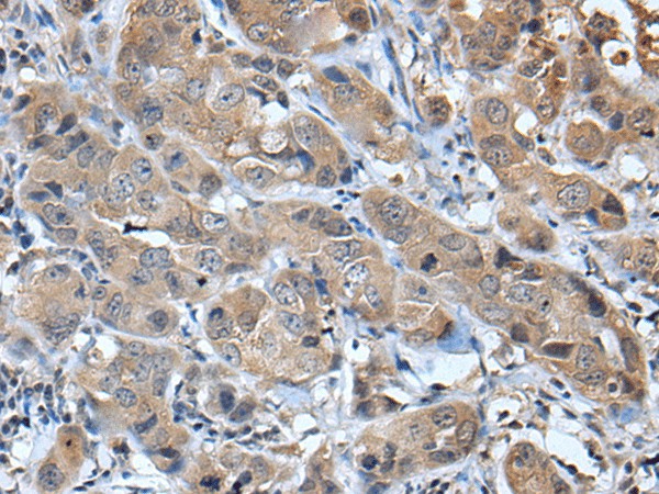 Immunohistochemistry of paraffin-embedded Human breast cancer tissue  using CXCL5 Polyclonal Antibody at dilution of 1:45(?200)