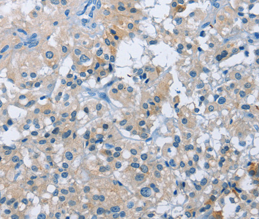 Immunohistochemistry of paraffin-embedded Human thyroid cancer tissue using BTN2A2 Polyclonal Antibody at dilution 1:50